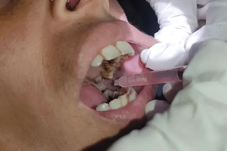 Intralesional Kanacort for OSMF - Dr Nikita Iyer