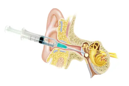 Intratympanic Dexamethasone Injections - Dr Nikita Iyer